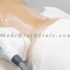 چربی سوزی شکم و پهلو با دستگاه لاغری چربی شکن