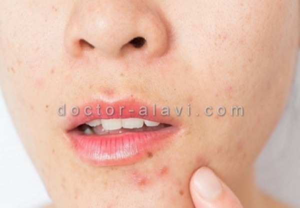 پاکسازی پوست و رفع جوش