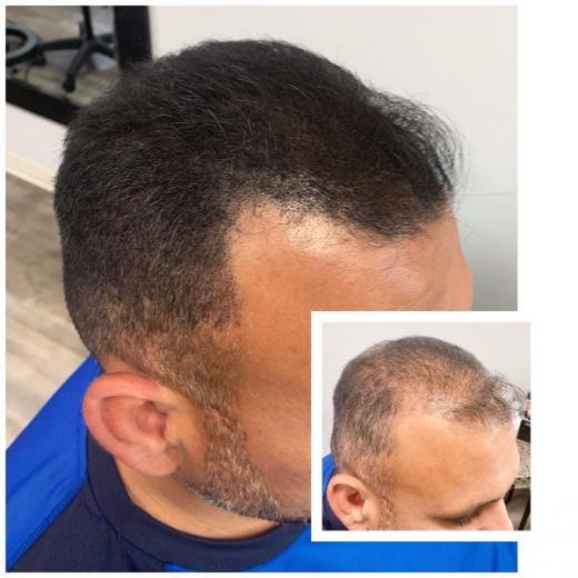 پرپشتی مو در یک جلسه با اسکالپ سر